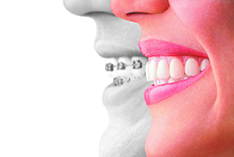 Invisalign® Treatment - Smiles at Summerhill Dental
